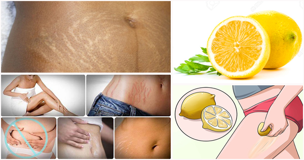Health Alert! Here’s How To Fade Stretch Marks Using Lime & Lemon
